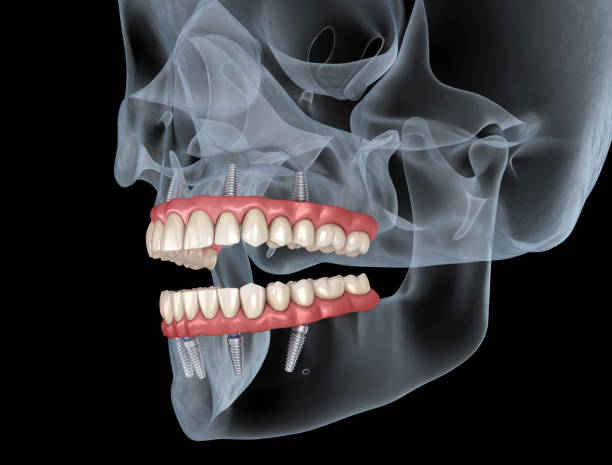 upper and lower prosthesis with gum all on 4 system supported by implants. medically accurate 3d illustration of human teeth and dentures - 4 5 år bildbanksfoton och bilder