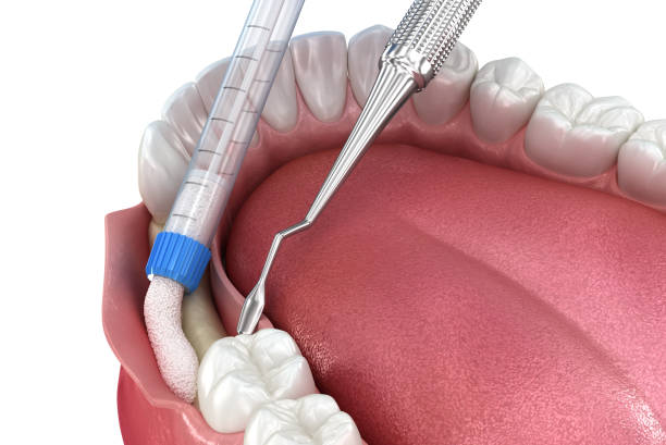 Bone grafting augmentation for tooth implantation. Medically accurate 3D illustration. stock photo
