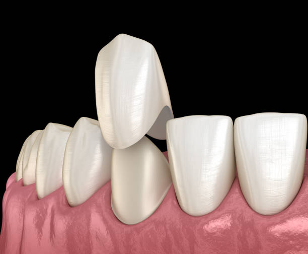 procedimiento de colocación de chapas. ilustración 3d de dientes médicamente precisa - corona-dental fotografías e imágenes de stock