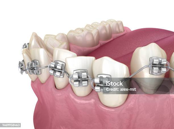 Abnormal Teeth Position And Correction With Metal Braces Tretament Medically Accurate Dental 3d Illustration Stock Photo - Download Image Now