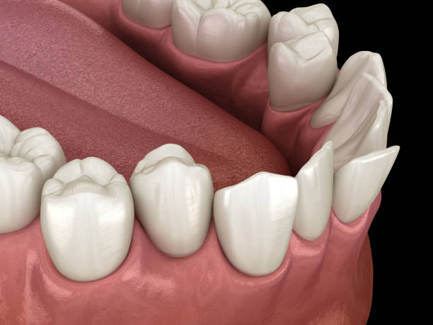 überfüllte zähne, abnorme zahnverschlüsse. medizinisch genaue zahn-3d-illustration - fehlbiss stock-fotos und bilder