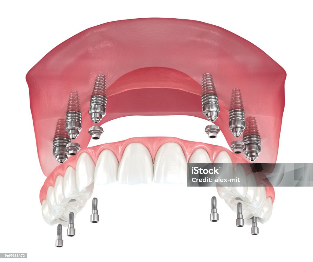 Maxillary Prosthesis Maxillary Prosthesis With Gum All On 6 System Supported By Implants ...