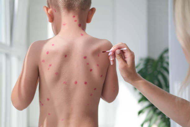 behandlung von geschwüren von windpocken, varizellen mit medizinischer creme auf der kinderhaut. mama behandelt den rücken des kindes mit roten medikamenten. - chickenpox skin condition baby illness stock-fotos und bilder