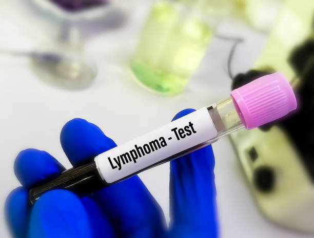 blood sample for lymphoma test. hodgkin lymphoma, non-hodgkin lymphoma. lymphoma is a cancer of lymphatic system. - non hodgkin lymphoma imagens e fotografias de stock