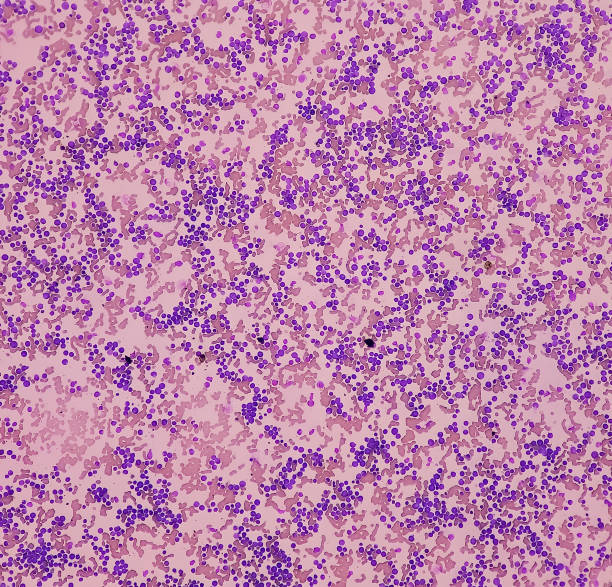 istock Acute myeloid leukemia (AML). Smear show monocytes and mostly blast cell. Anemia and thrombocytopenia. 1469986258