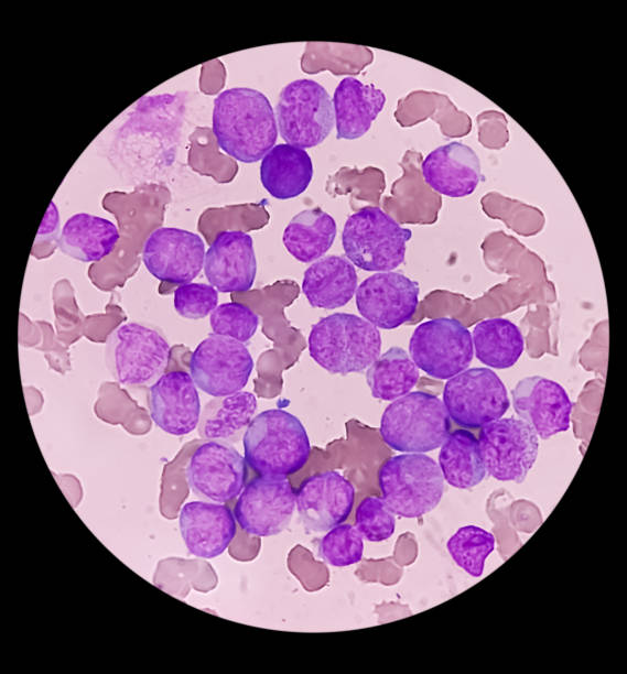 istock Acute myeloid leukemia (AML). Smear show monocytes and mostly blast cell. Anemia and thrombocytopenia. 1469986399