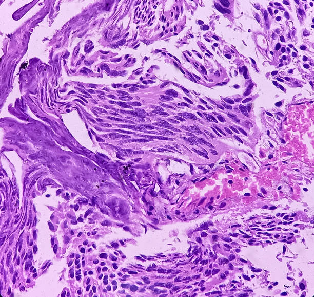 Urinary bladder cancer. Transitional cell carcinoma. show malignant neoplasm, Urinary bladder cancer. Transitional cell carcinoma. show malignant neoplasm, 40x view. lamina propria stock pictures, royalty-free photos & images