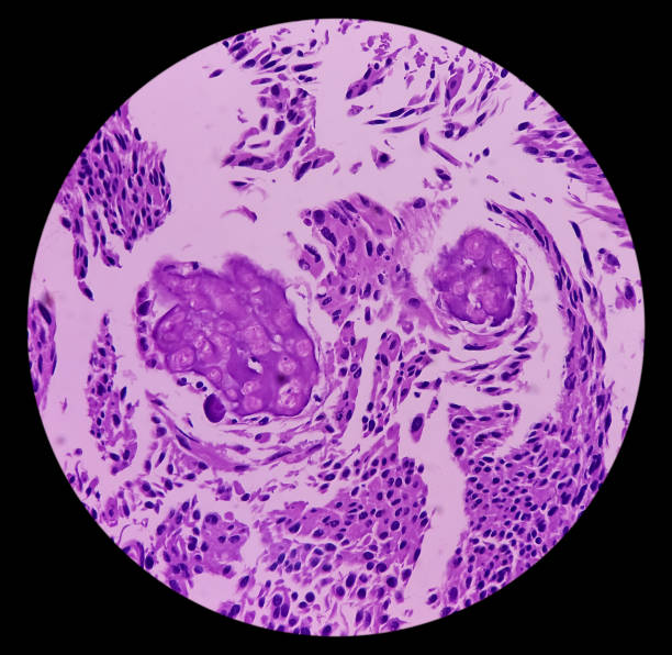 Urinary bladder cancer. Transitional cell carcinoma. show malignant neoplasm, Urinary bladder cancer. Transitional cell carcinoma. show malignant neoplasm, 40x view. lamina propria stock pictures, royalty-free photos & images