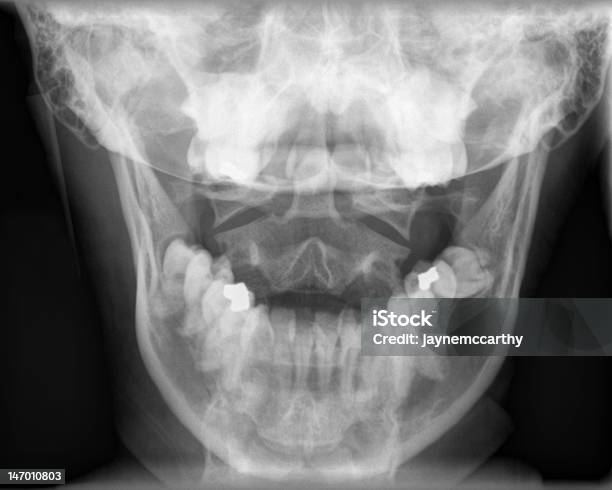 Mordaza De Rayos X Foto de stock y más banco de imágenes de Imagen de rayos X - Imagen de rayos X, Informe dental, Hueso maxilar humano