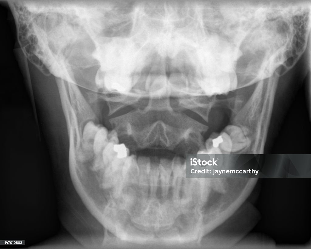 Jaw raio-X - Foto de stock de Imagem de raios X royalty-free