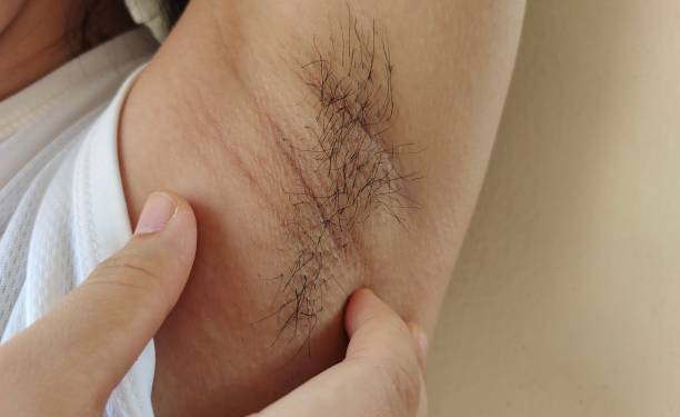 istock Armpit hair and chicken skin underarm. 1470124137