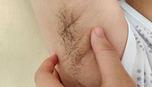 istock Armpit hair and chicken skin underarm. 1470124152