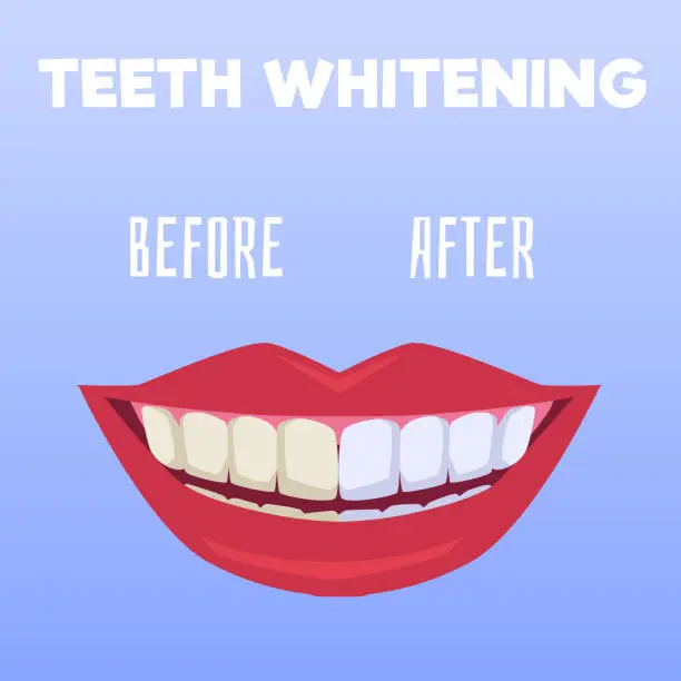 Vector illustration of Squared banner about teeth whitening flat style, vector illustration