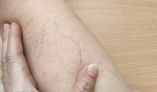 istock The varicose spider veins on the leg. 1470127409