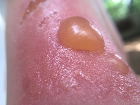 blisters on baby's skin sunburn