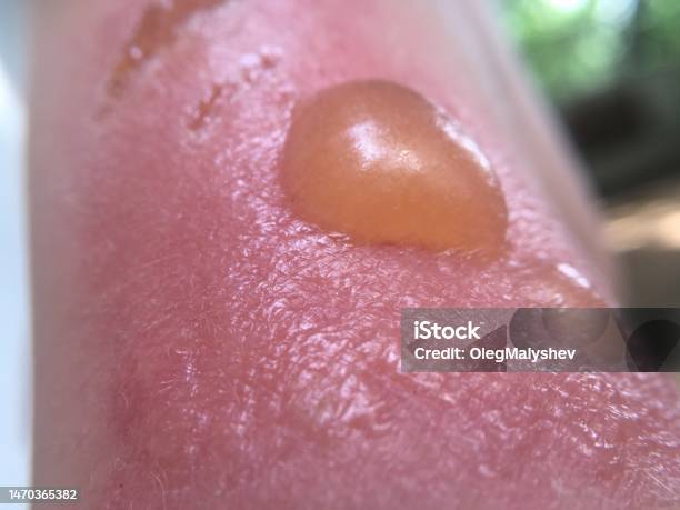 Sunburn Blisters On Babys Skin Stock Photo - Download Image Now - Blister, Burning, Sun