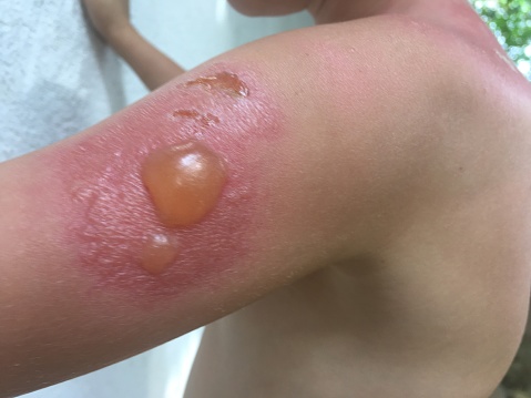 blisters on baby's skin sunburn