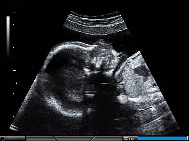 Baby, 23 weeks (photo by ultrasonography) stock photo