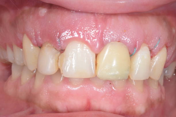 istock Dental clinical case of a ceramic crown. 1470426368