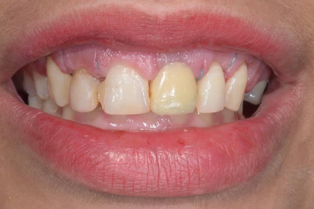 istock Dental clinical case of a ceramic crown. 1470426391