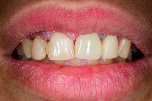 istock Dental clinical case of a ceramic crown. 1470427494