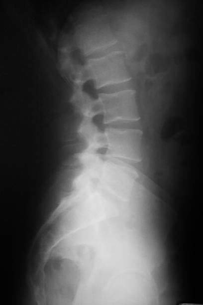 저해상 등근육 x-선 - x ray image x ray back low 뉴스 사진 이미지