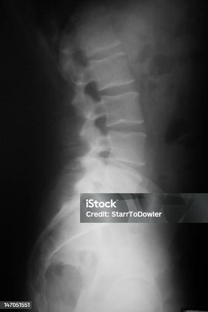 Low Back Rtg - zdjęcia stockowe i więcej obrazów Istota gąbczasta - Istota gąbczasta, Kręg człowieka, Staw międzywyrostkowy