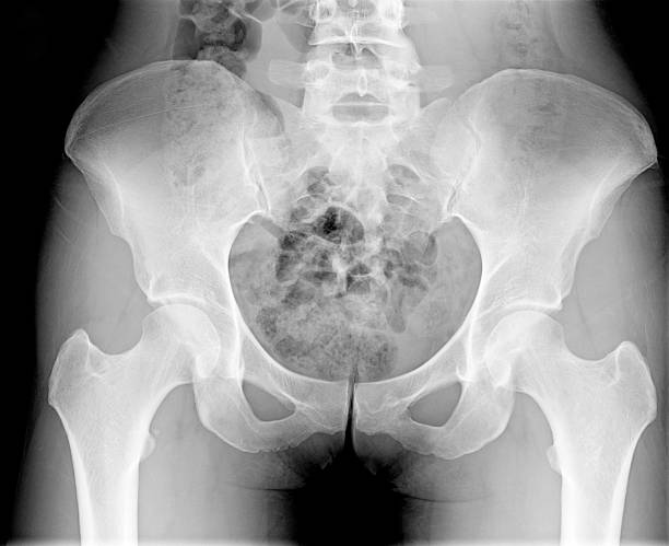 Female Pelvic / Pelivs Xray Xray of an adult female pelvis taken at a hospital.  The female is suffering from pelvic bone misalignment and a rotation of the L3 vertebrae.  Minor arthritis is beginning to show in the left hip socket/joint. No damage (cracks/fractures) to any bones or vertebrae found; diagnosis tentatively points to lower back sprain. coccyx photos stock pictures, royalty-free photos & images