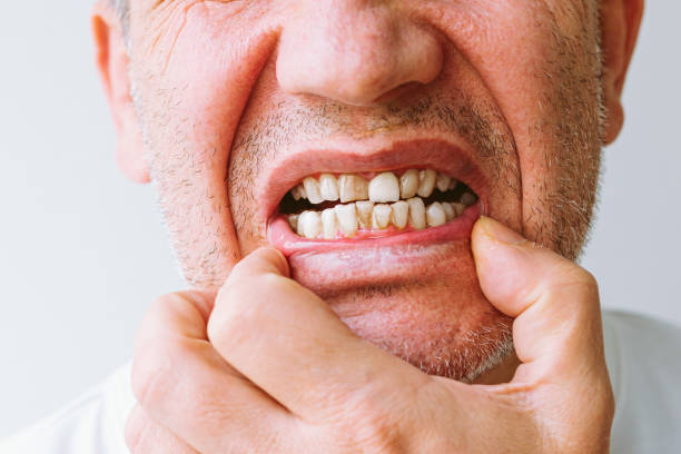 Close-up portrait of man showing teeth with tartar on white background teeth with lot of tartar, plaque. malocclusion, crooked teeth. concept of unhealthy teeth in need of treatment, braces, treatment at orthodontist. Close-up portrait of man showing teeth with tartar ugly face stock pictures, royalty-free photos & images