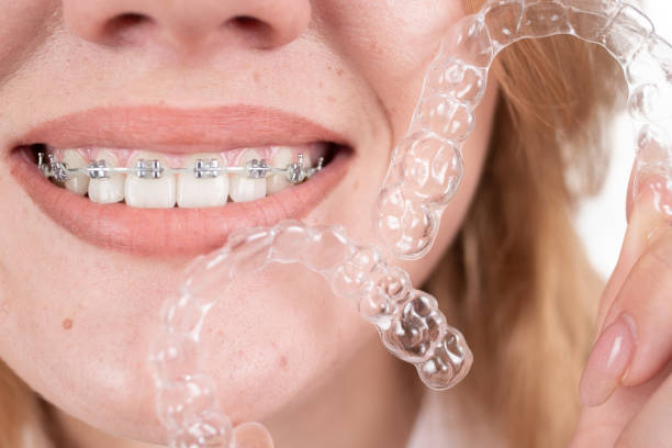 Dental care.Smiling girl with braces on her teeth holds aligners in her hands and shows the difference between them - https://media.istockphoto.com/id/1470533464/photo/dental-care-smiling-girl-with-braces-on-her-teeth-holds-aligners-in-her-hands-and-shows-the.jpg?s=612x612&w=0&k=20&c=qq7zWsGJI5-nJNVQzgInNfVBInpwpGB886hV87sv4LE=