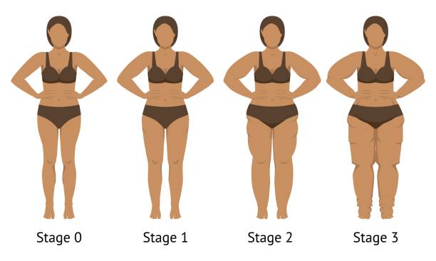 Women's body in different stages of Lipedema Women's body in different stages of Lipedema. Vector illustration obese joint pain stock illustrations