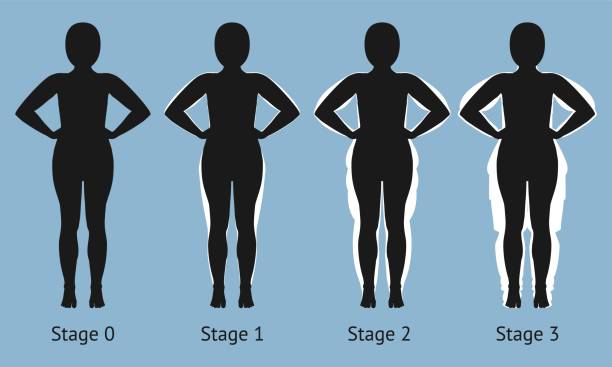 Women's body in different stages of Lipedema Women's body in different stages of Lipedema. Vector illustration obese joint pain stock illustrations