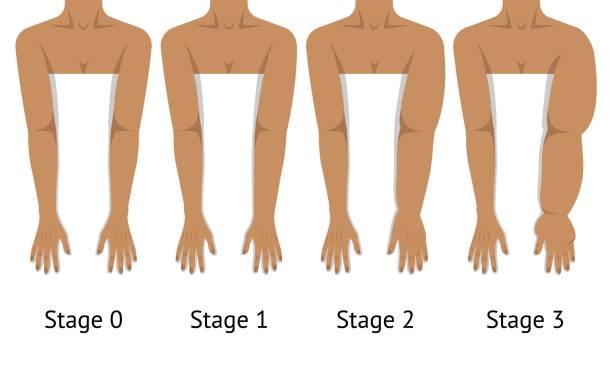 kuvapankkikuvitukset aiheesta naisten käsivarret lymfedeeman eri vaiheissa - turvonnut