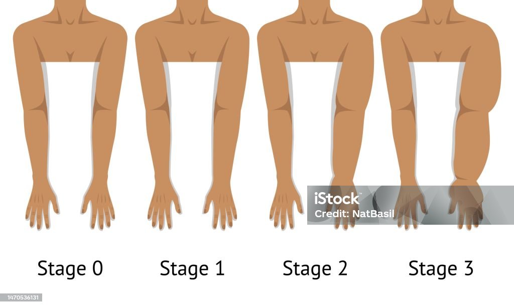 Women's arms in different stages of Lymphedema Women's arms in different stages of Lymphedema. Vector illustration Lymphedema stock vector