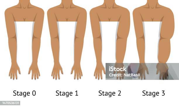 Womens Arms In Different Stages Of Lymphedema Stock Illustration - Download Image Now - Lymphedema, Arm, Healthcare And Medicine