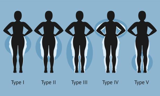 Women's body in different types of Lipedema Women's body in different types of Lipedema. Vector illustration obese joint pain stock illustrations