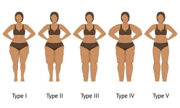 ciało kobiety w różnych typach obrzęków lipidowych - insufficiency stock illustrations