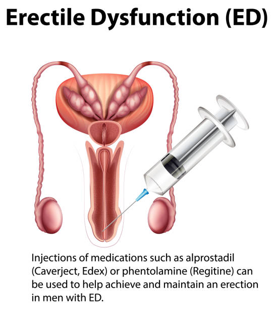 ilustrações de stock, clip art, desenhos animados e ícones de erectile dysfunction (ed) infographic with explanation - erectile dysfunction