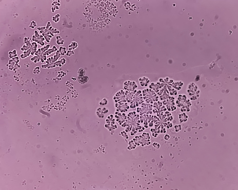 Microscopic fungi Malassezia furfur, showing yeast cells and hyphae. dermatophytes, Nail scraping or skin scraping for fungus test in microbiology laboratory.
