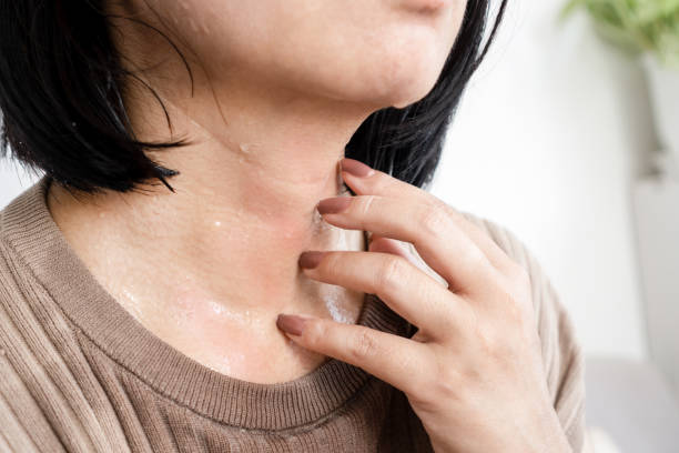 땀 알레르기로 목에 가려운 피부를 긁는 여성의 손을 클로즈업 - 땀 뉴스 사진 이미지