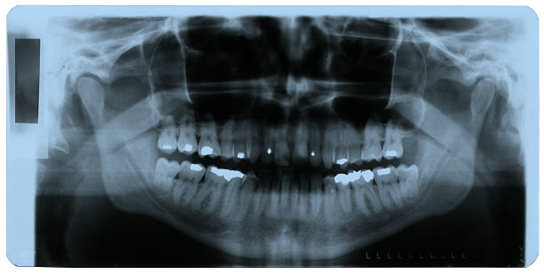 istock X-ray photo of human teeth 147075526