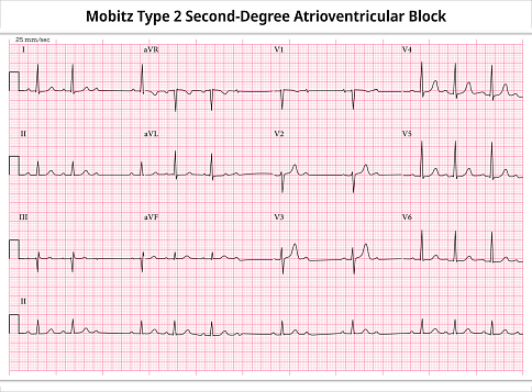 Mobitz Type 2 Second Degree Atrioventricular Block - ECG Paper 12 Lead - Electrocardiogram - Vector Medical Illustration