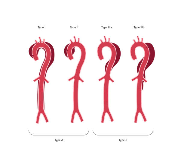 illustrazioni stock, clip art, cartoni animati e icone di tendenza di tabella infografica sull'anatomia dei vasi sanguigni. illustrazione piatta a colori vettoriali. sezione trasversale aortica con tipi di diagramma anatomico dell'aneurisma. design per la sanità, la cardiologia, l'istruzione. - aorta