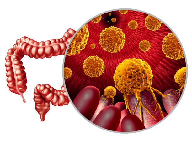 istock Colon Cancer Growth 1470988284