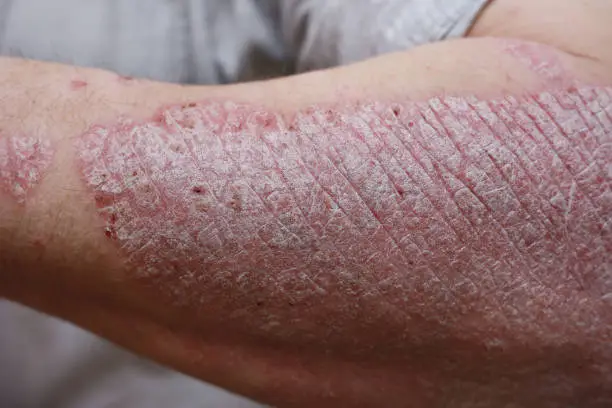 Photo of Close up, macro of psoriasis skin, autoimmune disease that affects the skin cause skin inflammation red and scaly. Skin allergy with severe symptoms. Dermatitis rash and ugly eczema.