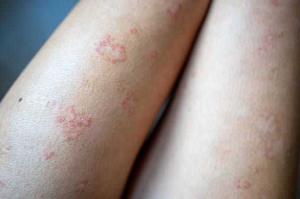 istock Asian legs and arm of Atopic dermatitis skin problem 1471181300