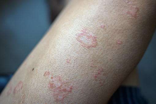 Asian legs and arm of Atopic dermatitis skin problem