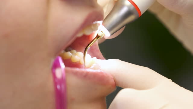 The dentist removing plaque and tartar from the woman's teeth