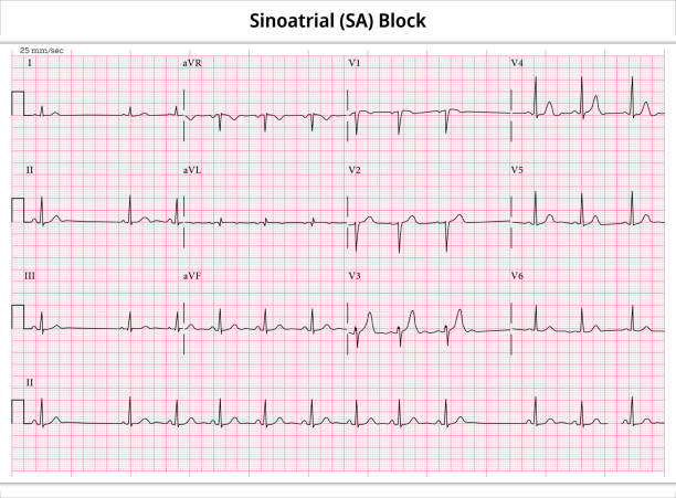 istock Sinoatrial (SA) Block - ECG Paper 12 Lead - Electrocardiogram 1471324739