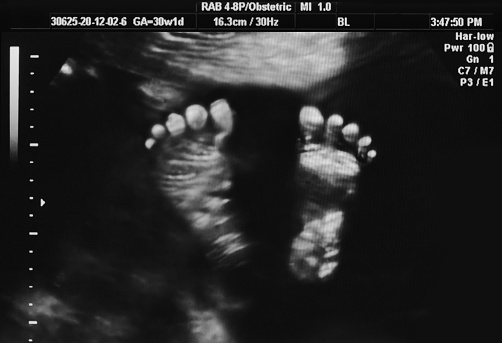 Ultrasound of baby at 30 weeks. Clearly showing the babies feet